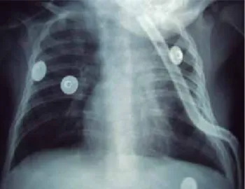 Figura 6. Radiografía normal de tórax. Seguimiento a dos años  de la cirugía.