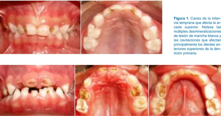 Figura 1. Caries de la infan-