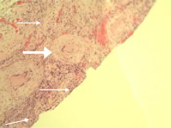 Figura 1. Laparoscopia con líquido libre en cavidad peritoneal, infil-