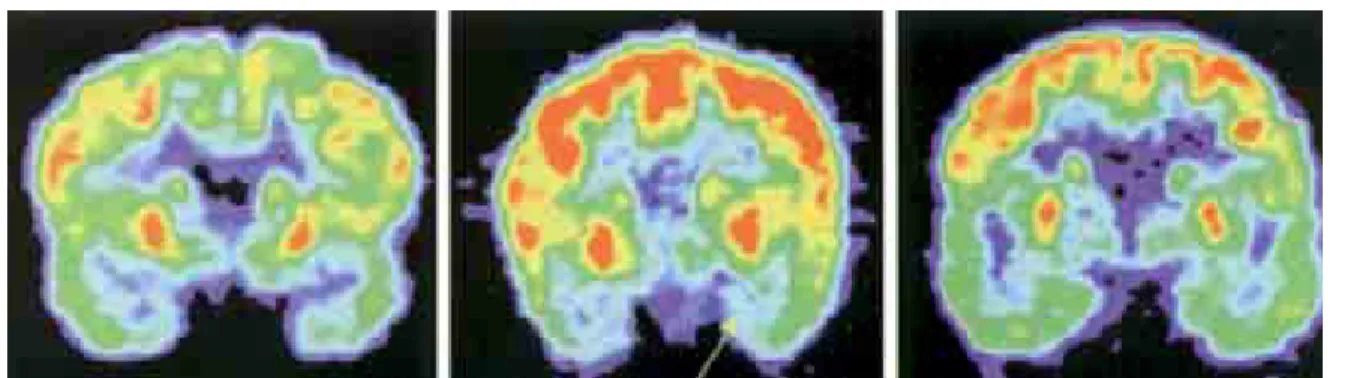 Figura 5. SPECT, cerebral en corte coronal, el cual muestra disminución bilateral de la perfusión cerebral predominantemente en las regiones temporales.
