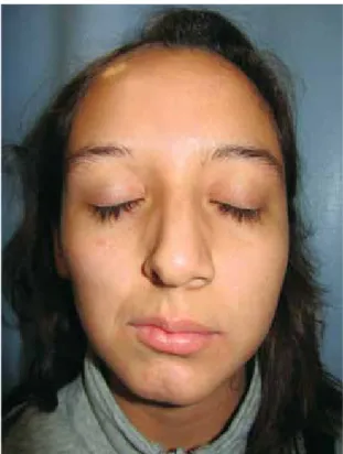 Figura 2: Desviación de las comisuras bucal y nasal.