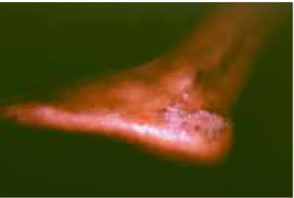 Figura 2. Acercamiento de la placa verrugosa. Figura 1. Eritema, escama y nódulos que conflu-yen formando una placa de aspecto verrugoso.