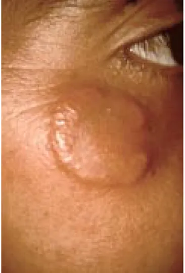 Figura 3. Corte histológico: (25x) Se observa el infiltrado de polimorfonucleares en dermis