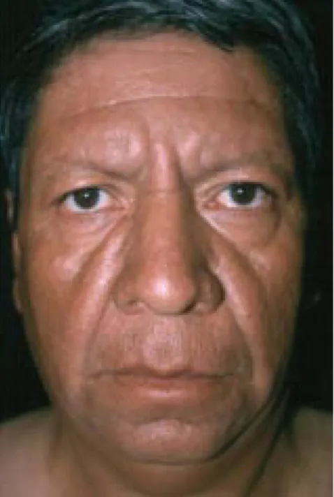 Figura 3. Infiltra-