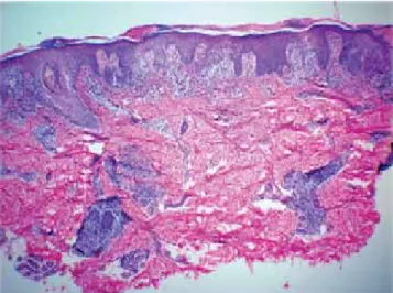 Figura 5.  Histopatología. En la epidermis se observa  hiperqueratosis ortoqueratósica y acantosis irregular  mo-derada