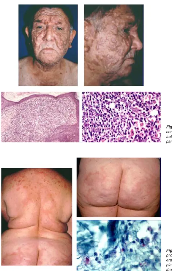 Figura 21. Linfoma diagnosticado
