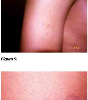 Figura 7. Biopsia. Epidermis acan-