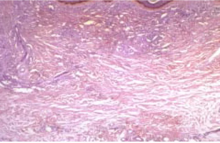 Figura 3. Enfermedad de Kaposi. Hendeduras vasculares en dermis superficial y profunda (H.E