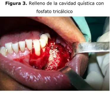 Figura 3. Relleno de la cavidad quística con  