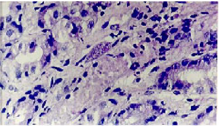 Figura 1.- Detalle microscópico en el que se identifica un quiste que contiene bradizoitos (forma latente del toxoplasma),  rodeado de una leve respuesta inflamatoria de tipo agudo, (P.A.S