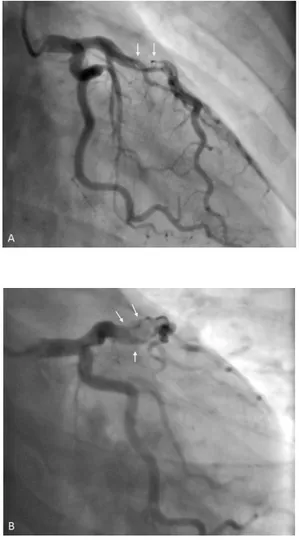 Figura 1. Ay B: Angiografía coronaria con defecto de   la   captación   del   medio   de   contraste   en   la arteria descendente anterior