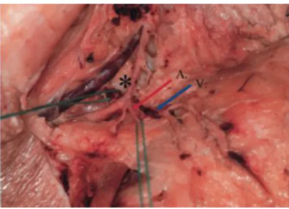 Figura 2 Anatomía vena supraclavicular 