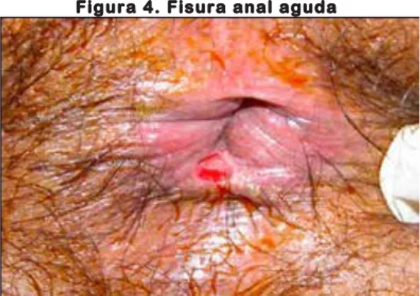 Figura 4. Fisura anal aguda 