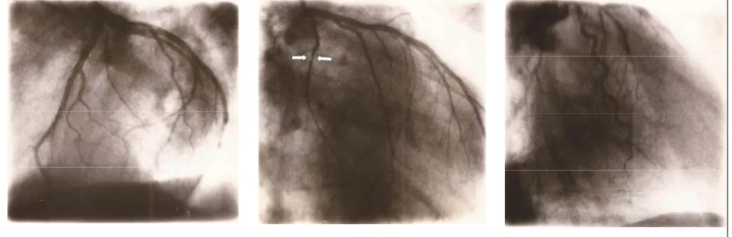 Figura 3. Aspecto imagenológico de la ateroesclerosis coronaria. Izquierda: Arteria coronaria izquierda