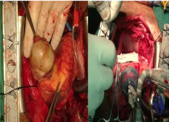 Figura  6.  Imágenes  transoperatorias.  A:  Muestra  el  PSA  ventricular  gigante  contenido  por  el  pericardio
