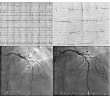 Figura 1: ECG previo en ritmo sinusal, ECG a la llegada a  urgencias  con  ondas  T  bifásicas  en  V2  y  V3  característica  del síndrome de Wellens de tipo A y coronariografía donde  se  observa  lesión  suboclusiva  del  95%  en  el  segmento  medio  d