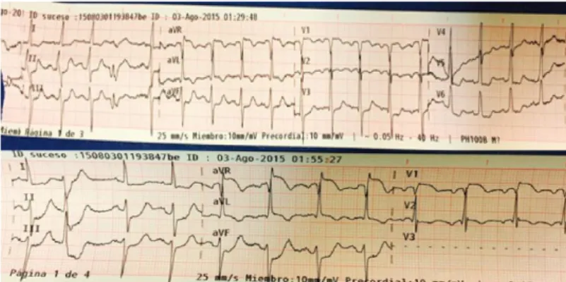 Figura  3:  ECG  prehospitalario  que  muestra  patrón  sugestivo de lesión severa del tronco coronario izquierdo, o  enfermedad arterial coronaria multivaso