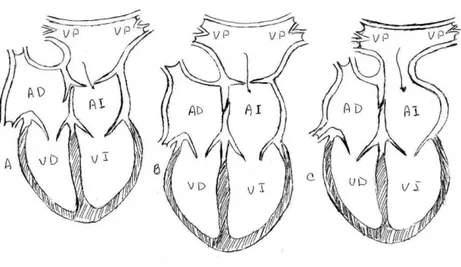 Figura 3.  Tipos anatómicos de cor triatriatum sinister. A) tipo diafragmático: existe un diafragma fibromuscular que separa el atrio izquierdo de la cámara 