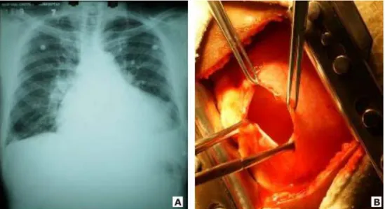 Fig. 2. A y B. Aumento de la silueta cardiaca por derrame agudo y 