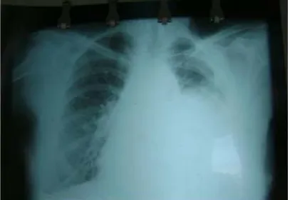 Fig. 4. Empiema a los 9 días de operado (paciente no. 1). 