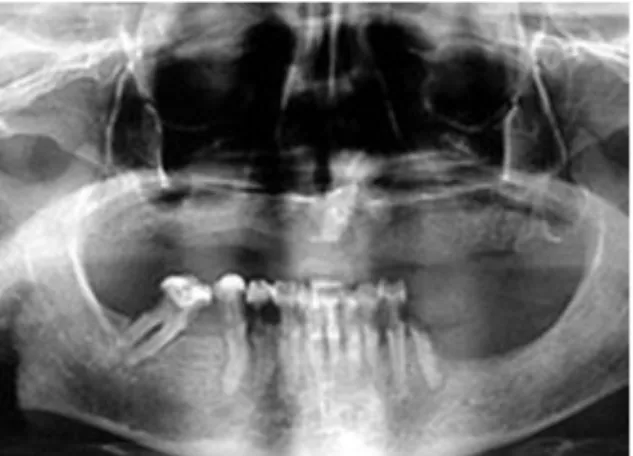 Fig. 2. Radiografia panorâmica, na qual se observam lesões  extensas 