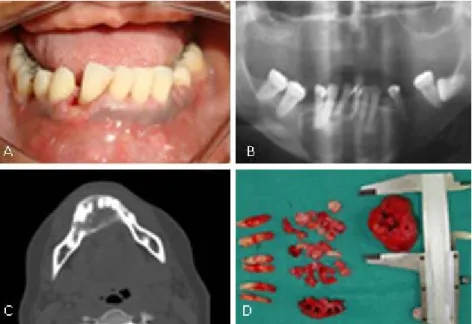 Fig. 1 – A: Clinical Front View. B: Panoramic radiography showed that there was a lesion