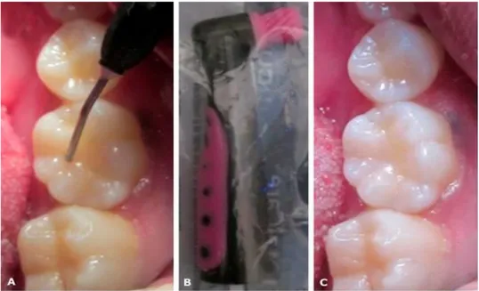 Fig. 2. A) Colocación de la resina compuesta fluida en el sitio de lesión  exacta del 36
