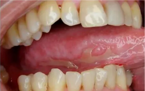 Fig. 1. Aspecto de las lesiones en el borde de la lengua. 