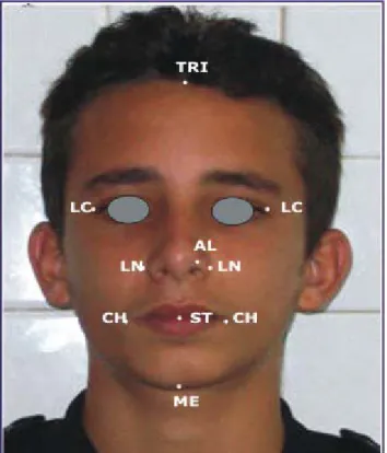 Fig. 1. Puntos de referencia empleados en las fotografías frontales. 