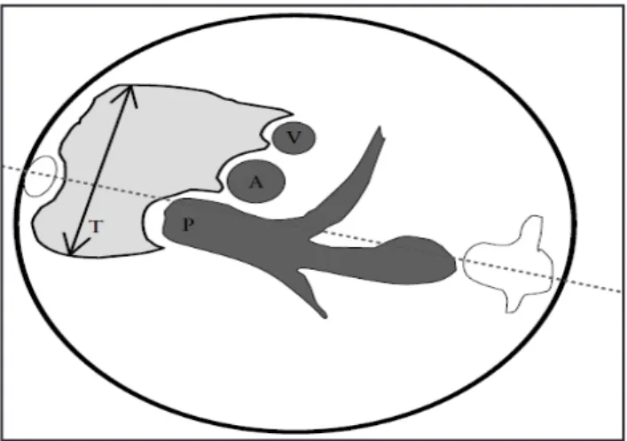 Figura  1.  Se  observa  imagen  de  los  tres  vasos    en  mediastino superior con la arteria pulmonar (P), aorta  (A) y vena cava superior (V) y por delante  el área del  timo fetal (entre las flechas).