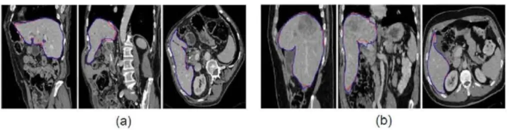 Fig. 1. From left to right, a sagittal, coronal and transversal slice for an easy case (a)  and a difficult one (b)