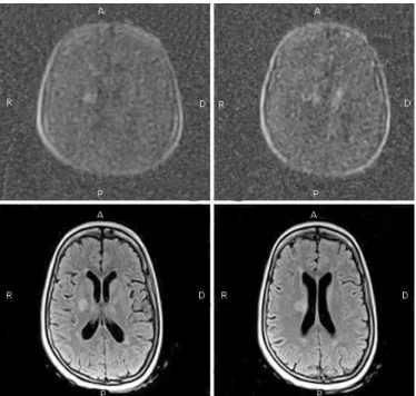 Fig. -  Abscesos cerebrales múltiples. A) Imágenes por difusión B) Imágenes flair axial
