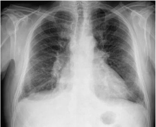 Fig. 3. Radiografía de tórax en proyección anteroposterior que muestra cardio- cardio-megalia (índice cardiotorácico del 60%), edema intersticial y derrame pleural  bi-lateral leve
