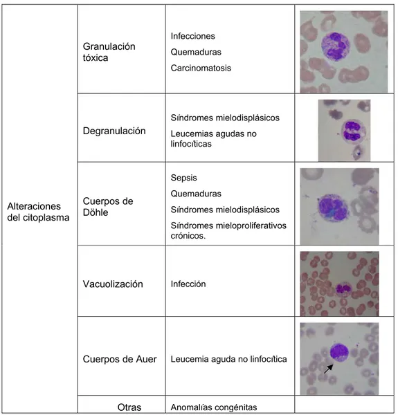 Tabla 7. Los leucocitos presentas alteraciones morfológicas en su citoplasma que nos pueden  orientar hacia una patología específica, en la tabla se enumeran las principales
