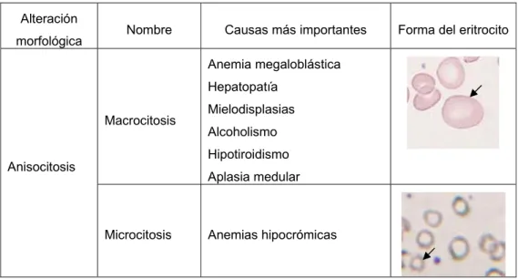Tabla 4. La anisocitosis  puede estar provocada por elementos  más grandes o pequeños de lo normal 
