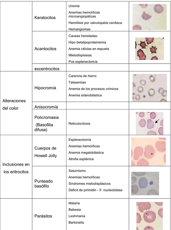 Tabla 5. Se describen los principales poiquilocitosis y sus causas, así como algunas inclusiones de los  eritrocitos y las enfermedades más importantes en las que se observan