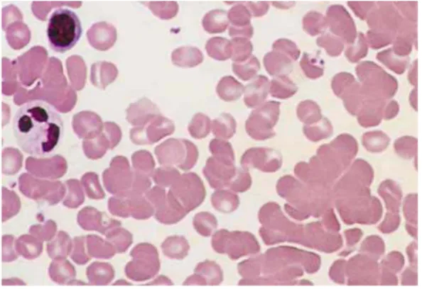 Fig. 7. Muestra de sangre periférica  que se describe de la siguiente  manera: anisocitosis ++, dada por  macrocitosis ++
