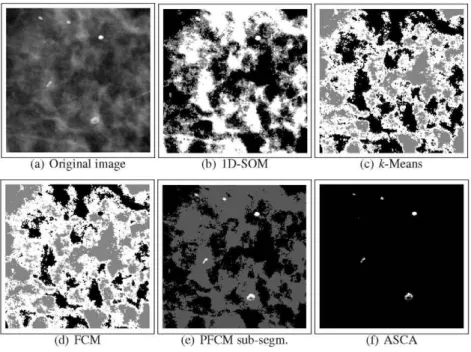 Fig. 3 Comparison of the segmentation results for a ROI mammogram, 256 x 256 pixels. The 