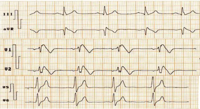 Fig. 4. ECG del caso 2 