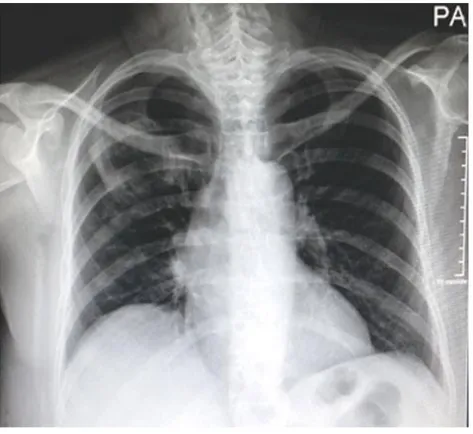Fig. 1 - Aspecto radiológico de la lesión pulmonar (imagen cavitada en el ápice del pulmón derecho y ligero  aumento de la trama vascular sin afectación ósea)