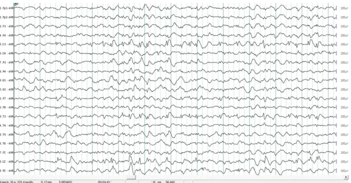 Figura 3. Descargas epileptiformes interictales en forma de punta–onda sobre la región central izquierda.