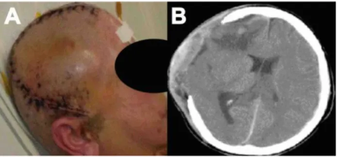 Figura 2. Craniectomía descompresiva fronto–temporo– parieto–occipital  unilateral.  A