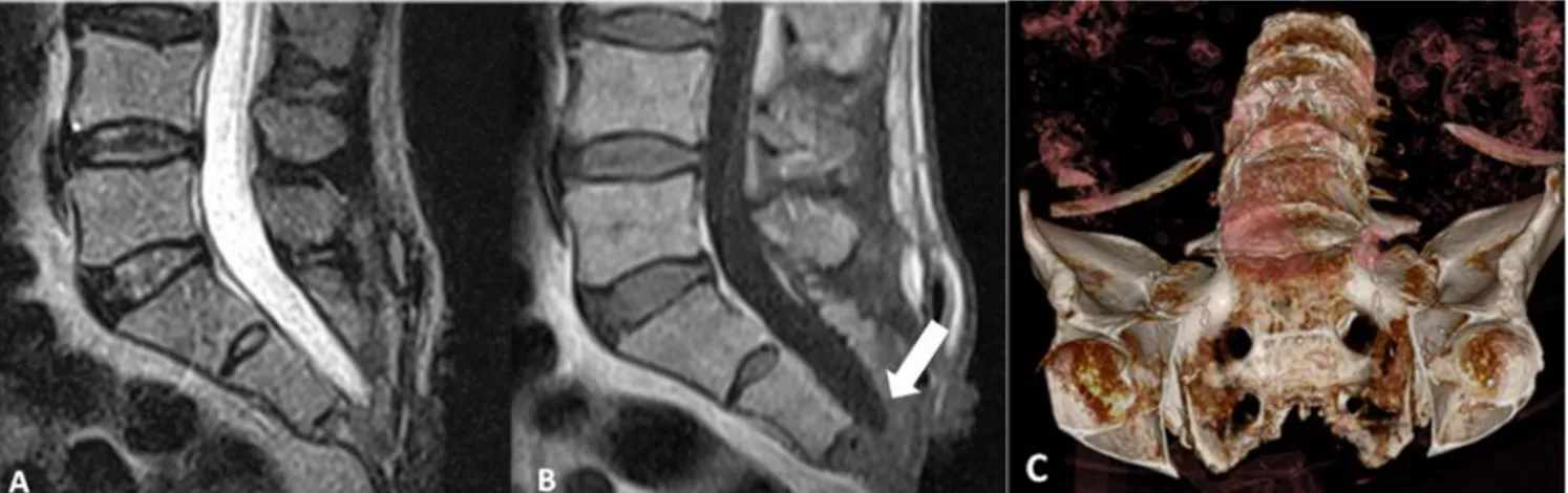 Figura  3.  Imágenes  de  control  postoperatorias.  A  y  B.  Imágenes  de  resonancia  magnética  (T1-T2)  donde  se  observa  la  remoción  total  de  la  lesión  tumoral