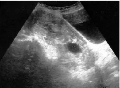 Fig. 1 – Útero que evidencia pequeño engrosamiento endometrial  