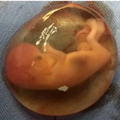 Fig. 2 - Saco gestacional conteniendo el embrión. 
