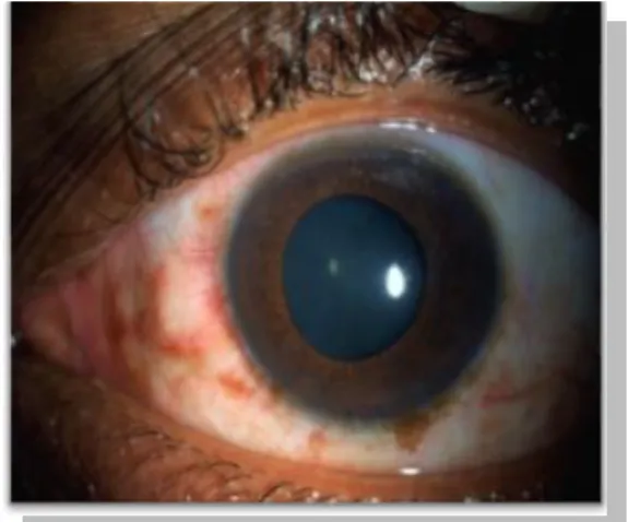Fig. 3. Segmento anterior del ojo derecho, 