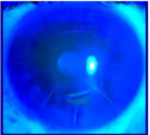Fig. 1. Imagen del ojo derecho en el preoperatorio. 