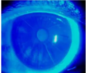 Fig. 4. Imagen del ojo derecho en el preoperatorio. 