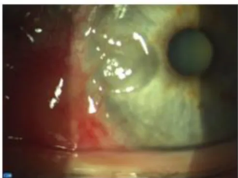 Fig. 1. Se observa dellen corneal vascularizado,  