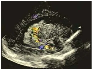 Fig. 4 - Imagen bidimensional longitudinal. La ecografía doppler codificada a color permite  la visualización del flujo sanguíneo turbulento que pertenece a la vía arterial aferente